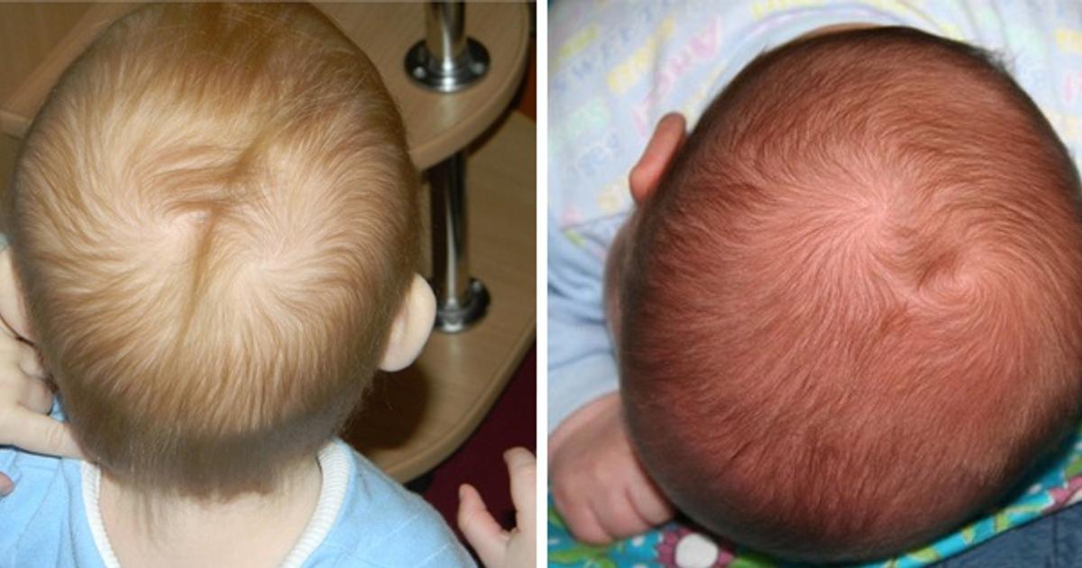 Почему у ребенок может родиться с белым пятном на волосах
